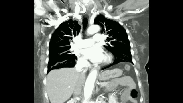 CT胸部注射造影剂冠状面。视频素材