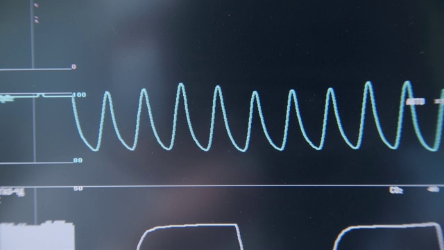 带重症监护病房病人心电图的现代医疗设备监视器视频素材