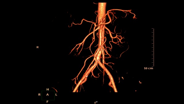 CTA腹主动脉或CTA肾动脉三维渲染图像在屏幕上翻转。视频素材