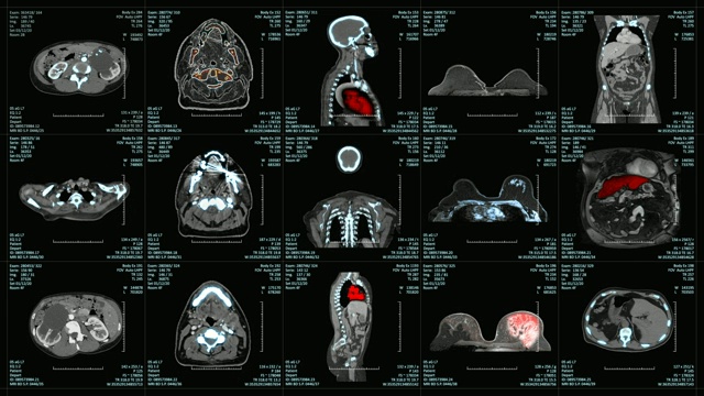 核磁共振扫描屏幕附加医疗数据视频素材
