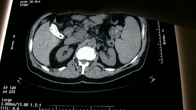 巨大的胆结石视频素材