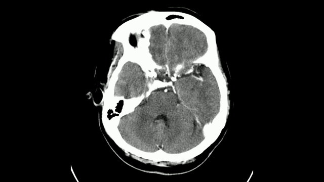 脑室内出血脑低密度左基底神经节出血累及颞额顶叶，中线结构向基底神经节转移视频下载