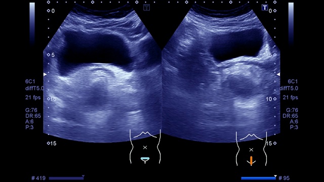 超声波整个腹部。视频下载
