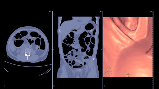 CT结肠镜视频素材