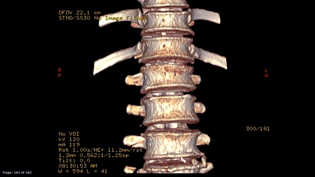 胸腰椎CT扫描图像。视频素材