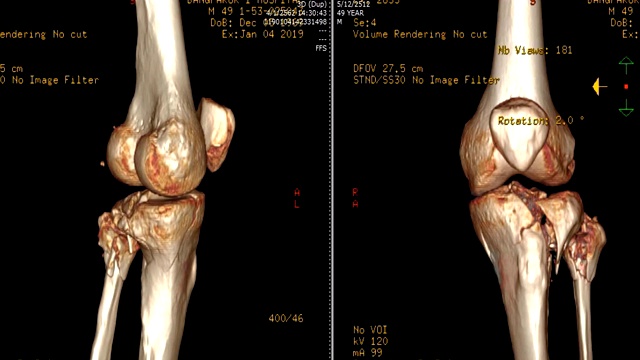 左膝CT扫描图像。视频素材