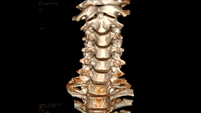 颈椎CT扫描视频素材
