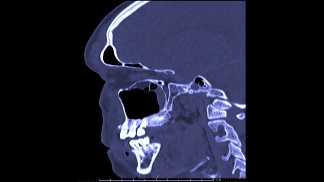 CT脑部矢状面扫描。视频素材