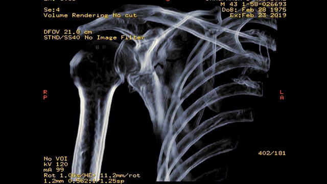 右肩CT显示骨折肩胛骨三维渲染图像视频素材