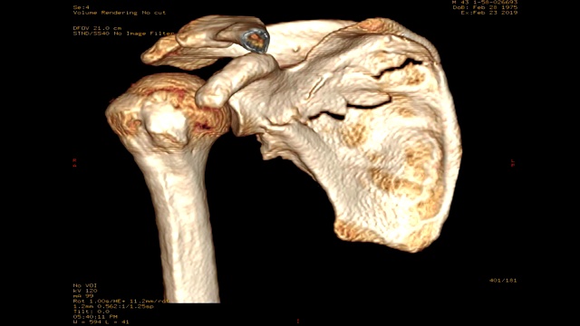 右肩CT显示骨折肩胛骨三维渲染图像。视频素材