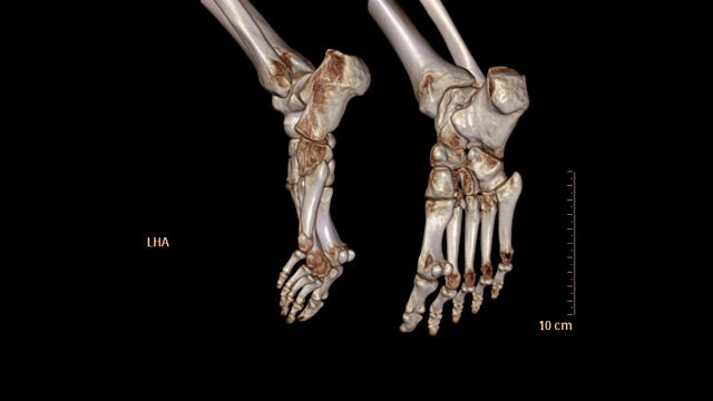 CT扫描的双脚3D渲染图像在屏幕上旋转。视频素材