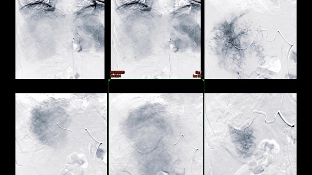介入放射科多屏肝脏血管成形术的透视图像。视频素材