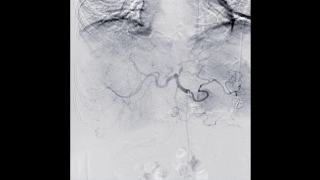 介入放射科屏幕上肝脏血管成形术的荧光图像。视频素材