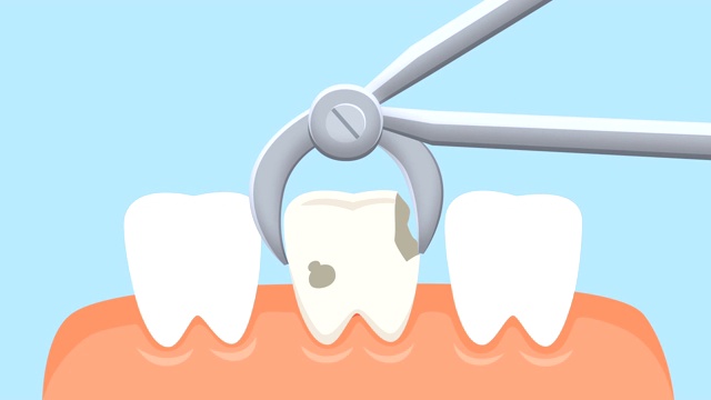 拔牙动画。牙医的接待视频素材