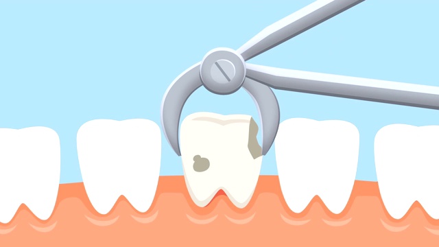 拔牙动画。牙医的接待视频素材