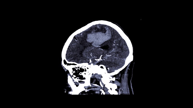 ct血管造影，CTA脑部三维矢状面图像显示脑部血管。视频素材