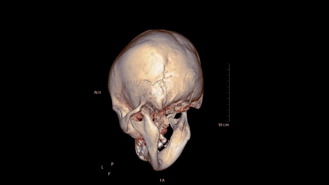 外伤患者颅骨或面骨的CT扫描显示上颌骨骨折的三维渲染图像。医疗技术的概念。视频素材