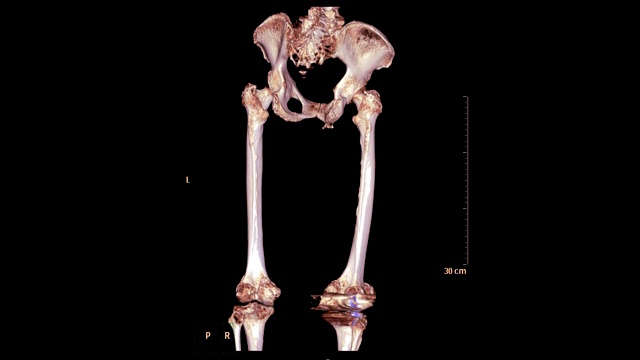骨盆骨的CT扫描包括股骨的3d渲染图像的翻转屏幕。视频素材
