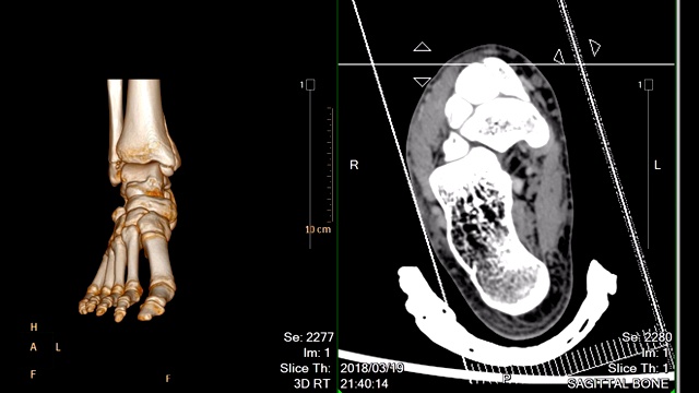 CT足部或双足扫描3D渲染图像对比3D图像和2D矢状面显示胫骨远端骨折。视频素材