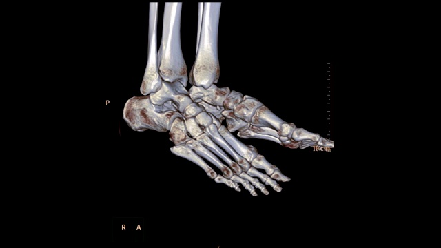 CT足部或双足3D渲染图像扫描在屏幕上旋转显示胫骨远端骨骨折。视频素材