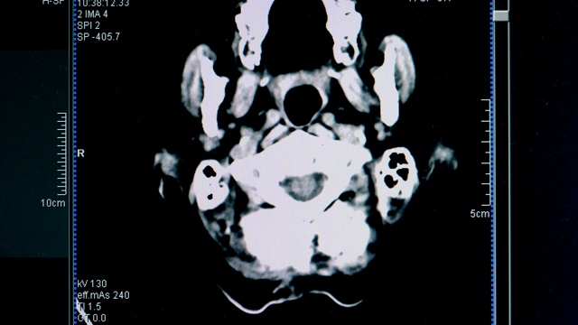 脑部扫描图像在显示器上逐渐消失视频素材