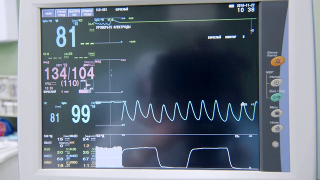 具有病人心电图和其他参数的现代医疗设备监视器视频素材