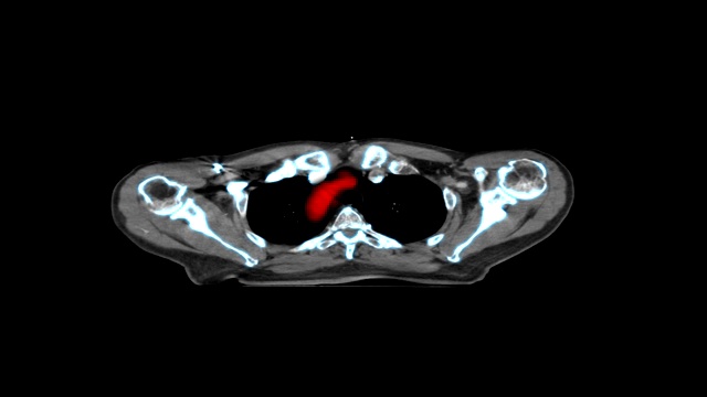 医学MRI扫描屏幕，CT或CAT扫描图像视频素材