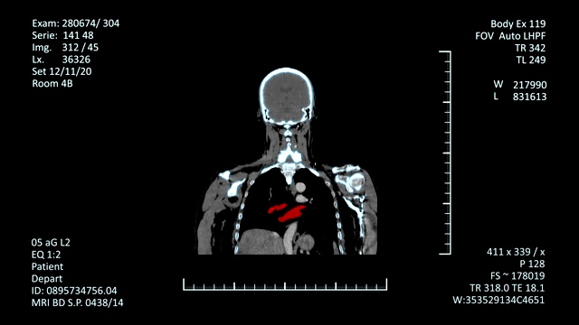 医学MRI扫描仪显示，CT或CAT图像视频素材