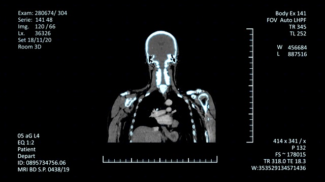 医学MRI扫描仪显示，CT或CAT图像视频素材