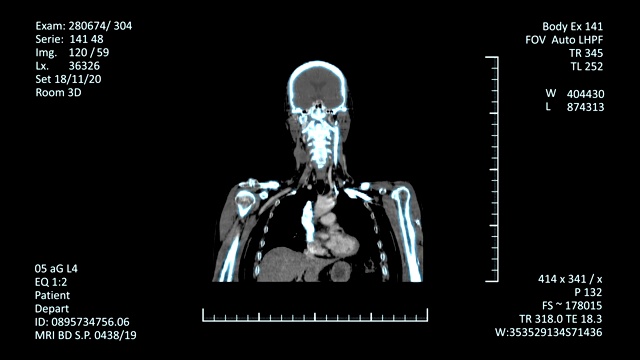 医学MRI扫描屏幕，CT或CAT图像视频素材