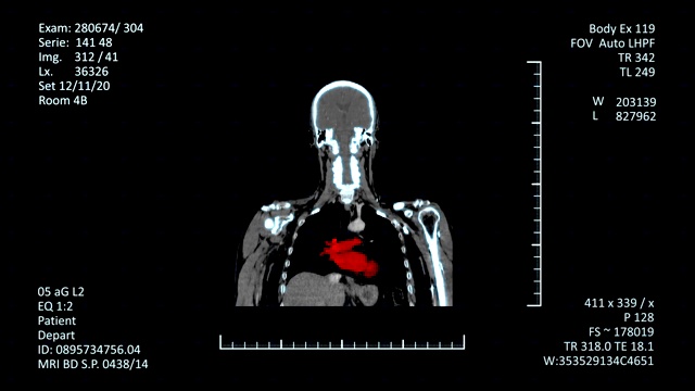 医学MRI扫描仪显示，CT或CAT图像视频素材