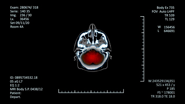 医学x射线成像放射学检查视频素材