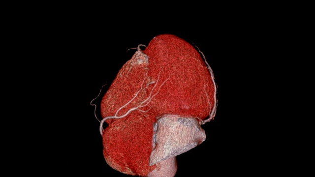 CTA冠状动脉三维渲染图像心脏和血管冠状动脉在屏幕上旋转。视频素材