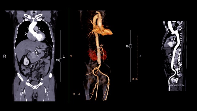CTA腹主动脉对比冠状面、三维渲染图像和曲线MPR。视频素材