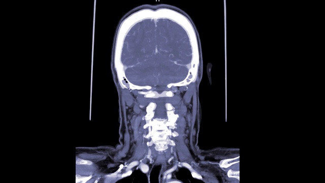 脑冠状面CT扫描。视频素材
