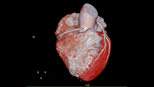 冠状动脉CTA三维成像心脏和血管冠状动脉。视频素材
