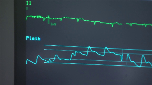 医院的心率监测器视频素材