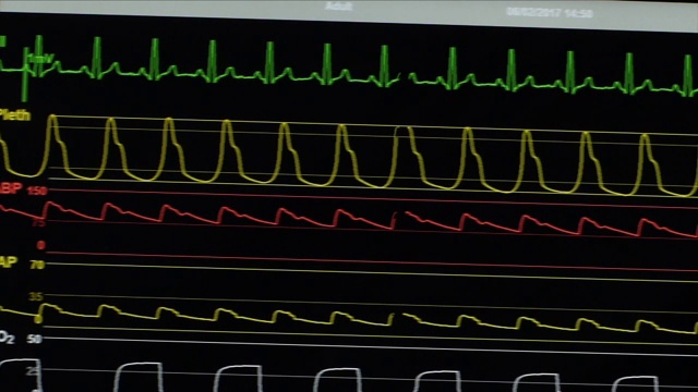 医院的心率监测器视频素材