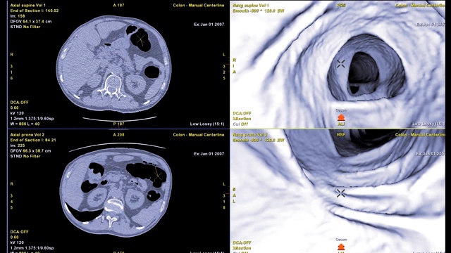 CT结肠镜比较轴向和3D电影文件筛查大肠癌。检查结肠癌筛查。视频素材