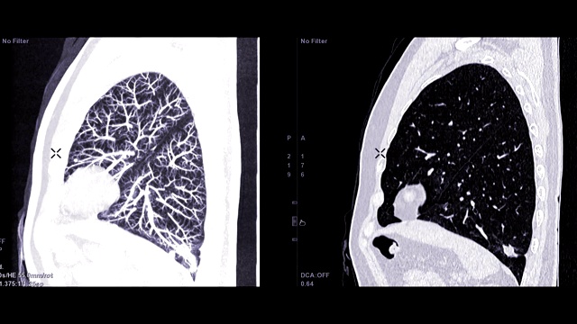 CTA胸部对比矢状MIP和矢状2D诊断肺栓塞(PE)和肺癌。视频素材