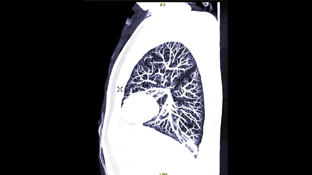 CTA胸部造影剂矢状位MIP图诊断肺栓塞(PE)和肺癌。视频素材