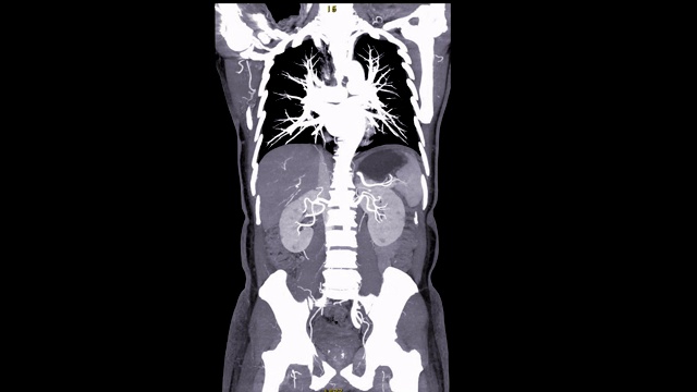 CTA腹主动脉冠状动脉MIP视图，慢镜头4k。视频素材