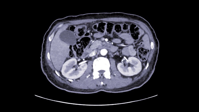 CTA腹主动脉轴位图。4k慢镜头。视频素材