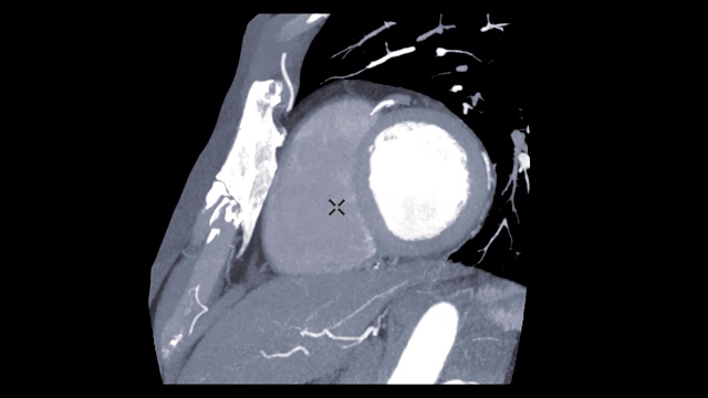 CTA冠状动脉轴位图像名称为短轴面。视频素材