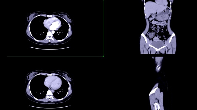CT全腹比较V期与延迟期轴位及冠状、矢状面示主动脉强化，诊断腹部疾病及肿瘤。视频素材