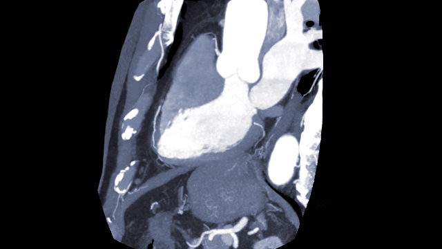 CTA冠脉三维渲染图像在屏幕上旋转，用于冠脉狭窄的血管诊断。视频素材