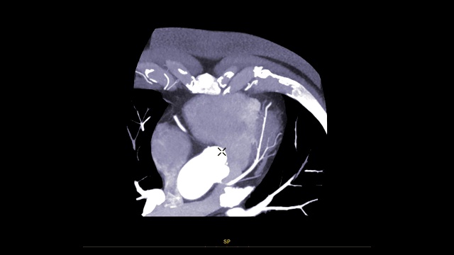 CTA冠状动脉长轴平面。视频素材