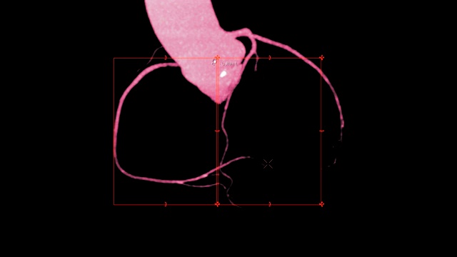 CTA冠脉三维渲染图像在屏幕上旋转，用于冠脉狭窄的血管诊断。视频素材