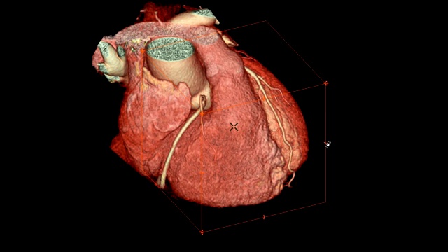 CTA冠脉三维渲染图像在屏幕上旋转，用于冠脉狭窄的血管诊断。视频素材