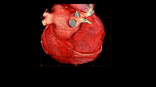 CTA冠脉三维渲染图像在屏幕上旋转，用于冠脉狭窄的血管诊断。视频素材